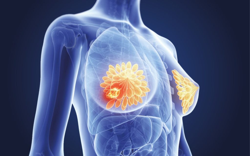 Digital illustration of a female chest showing internal anatomy, highlighting the breast tissue with one breast featuring a bright spot, possibly indicating a tumour or abnormality. The image is semi-transparent with anatomical details visible.