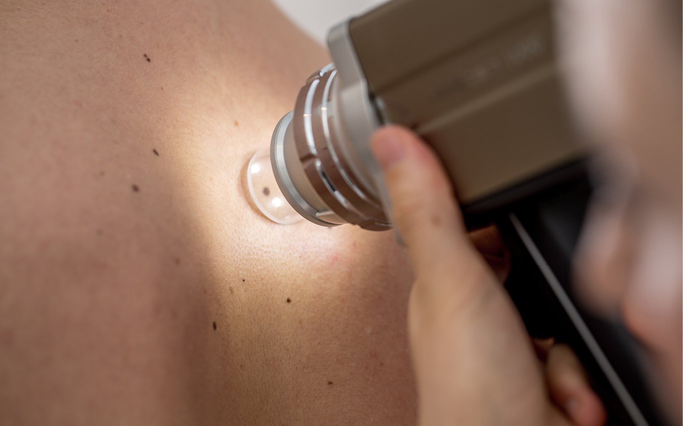 A person's skin is examined for signs of cancer