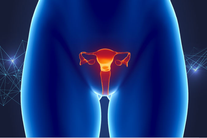 Anatomical graphic of cervical cancer