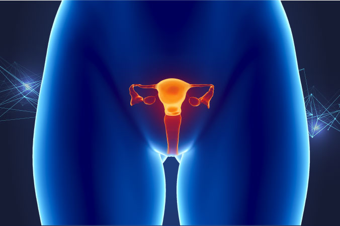 Anatomical graphic of endometrial cancer