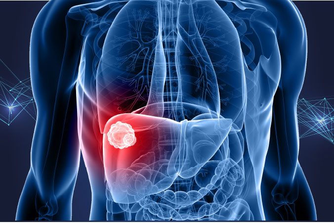 Anatomical graphic of liver cancer