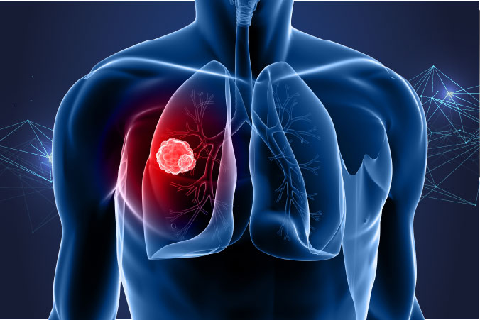 Anatomical graphic of lung cancer