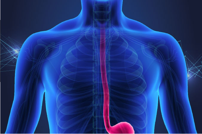 Anatomical graphic of oesophageal cancer