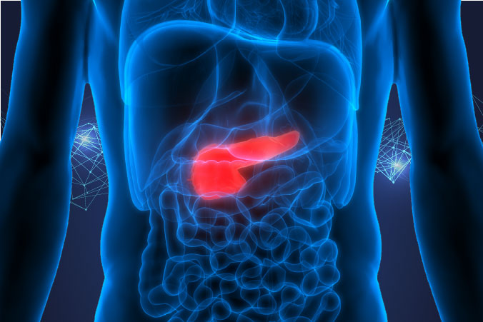 Anatomical graphic of pancreatic cancer