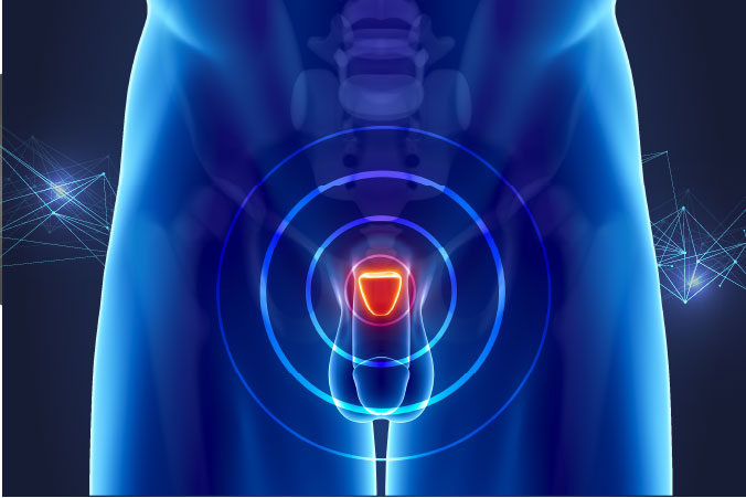Anatomical graphic of prostate cancer