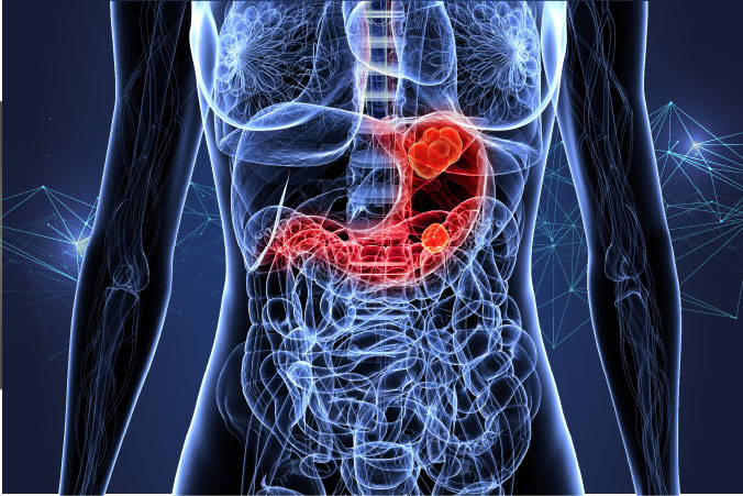 Anatomical graphic of stomach cancer