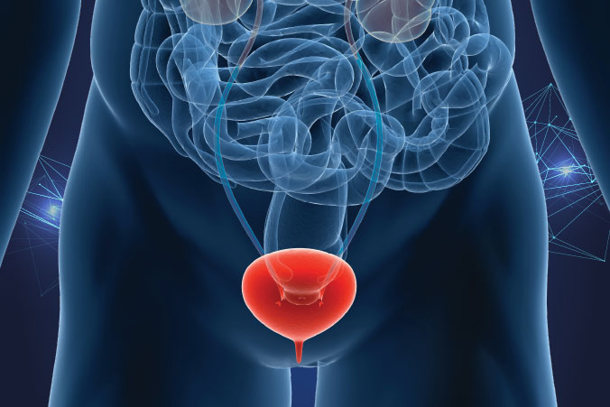 Anatomical graphic of bladder cancer