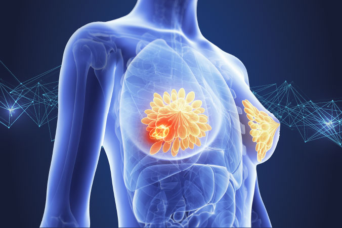 Anatomical graphic of breast cancer