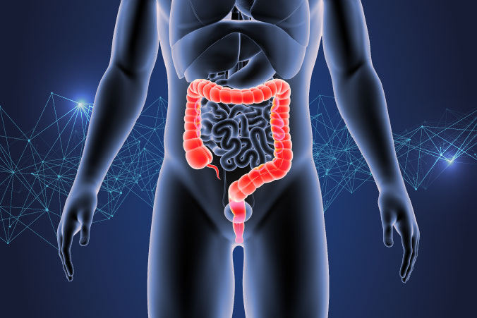 Anatomical graphic of colorectal cancer