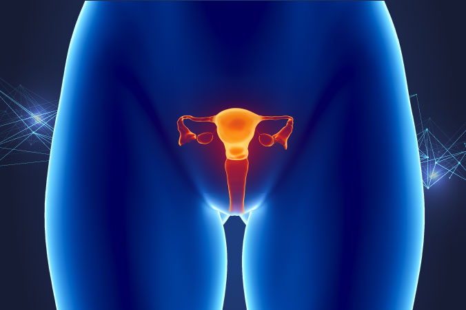 Anatomical graphic of endometrial cancer