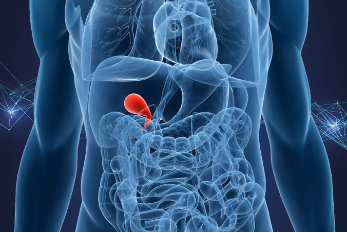 Anatomical graphic of gallbladder cancer