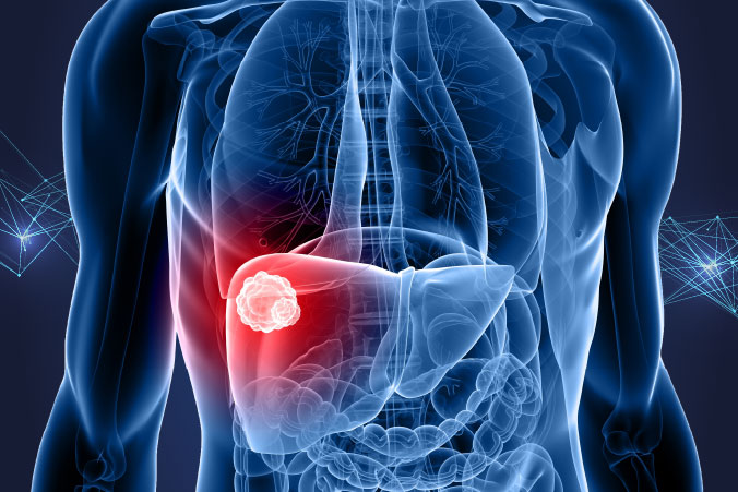 Anatomical graphic of kidney cancer