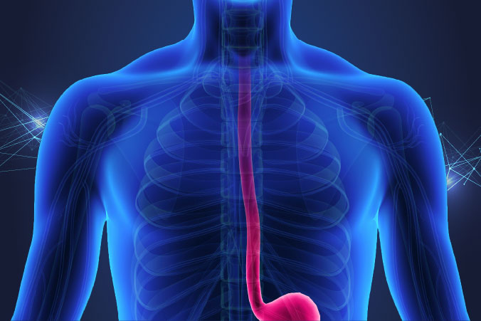 Anatomical graphic of oesophageal cancer