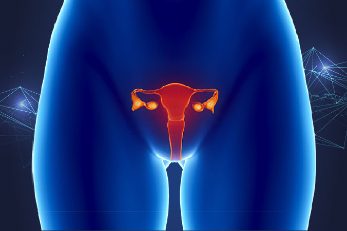 Anatomical graphic of ovarian cancer