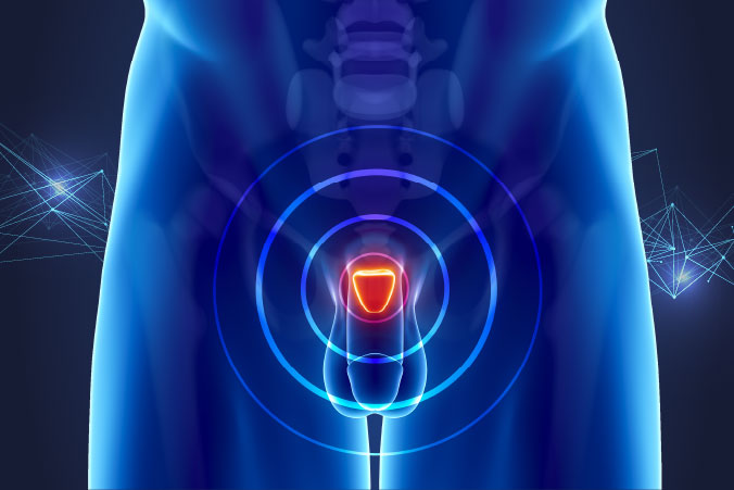 Anatomical graphic of prostate cancer