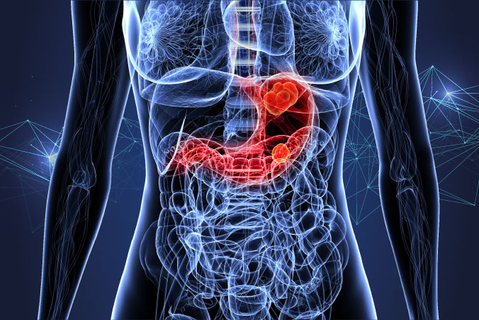 Anatomical graphic of stomach cancer
