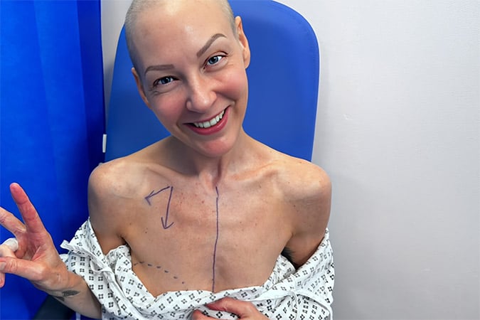 A smiling person with a bald head sits in a hospital gown on a blue chair. Marks are drawn on their chest, including an arrow and a vertical line. They hold up two fingers in a peace sign.